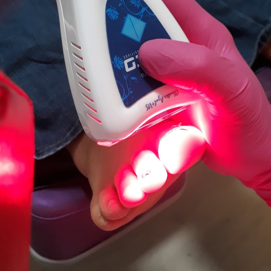 Terapia com LED em tratamento podológico
